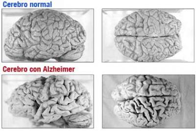 Una nueva técnica para detectar las lesiones precoces en pacientes con riesgo de Alzheimer