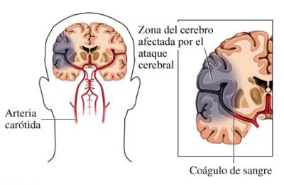 Trombosis Cerebral - Trombosis Venosa Cerebral Que Hay Tras La ...